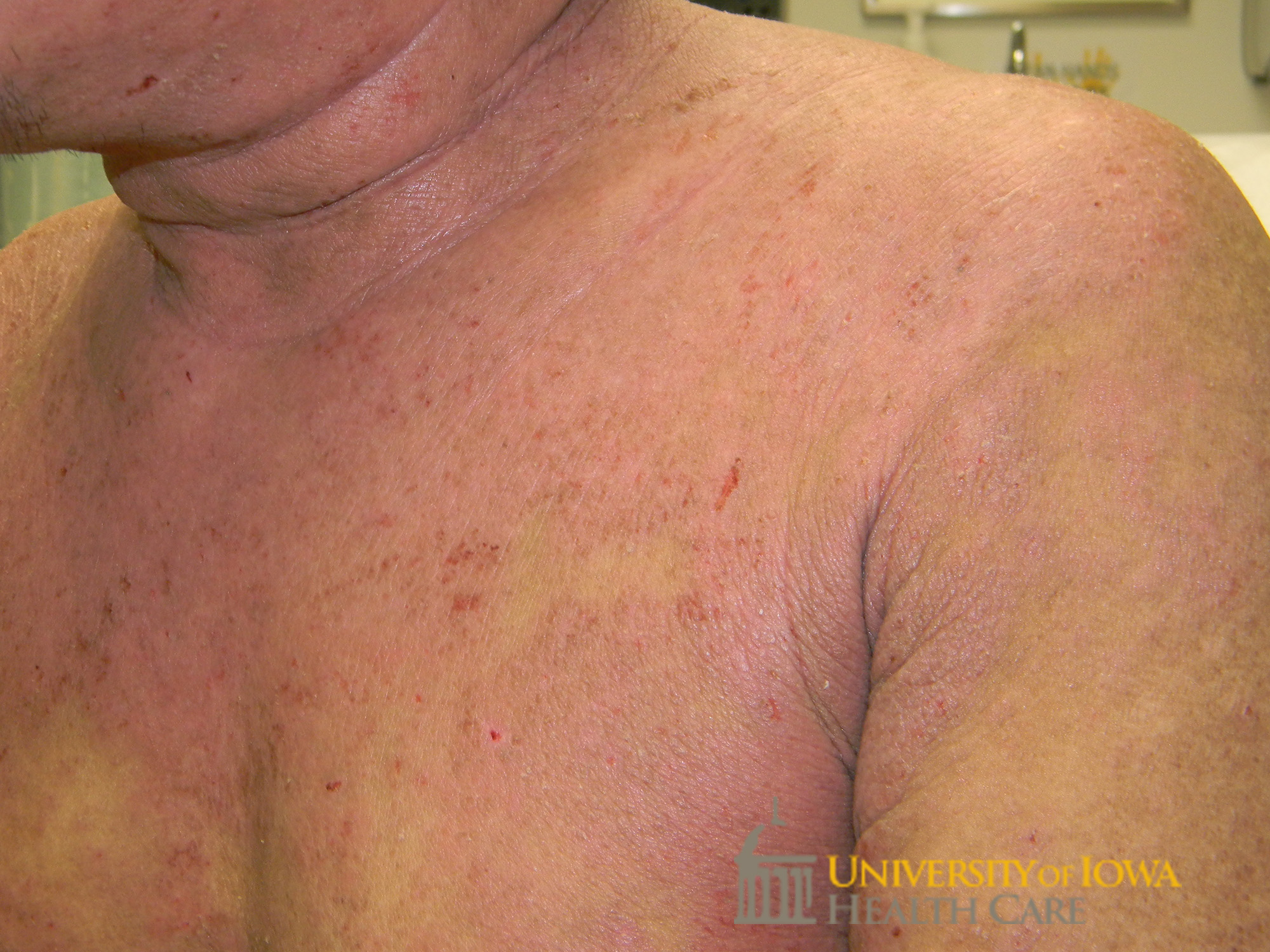 Erythematous scaly plaques with fissures and the trunk and extremities. (click images for higher resolution).